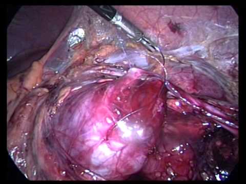 Lap Pyeloplasty For Ureteric Stricture Unedited