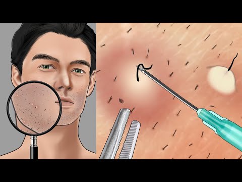 [ASMR] 사각사각 면도소리 + 인그로운헤어 뽑기 / Shaving sound + ingrown hair removal animation