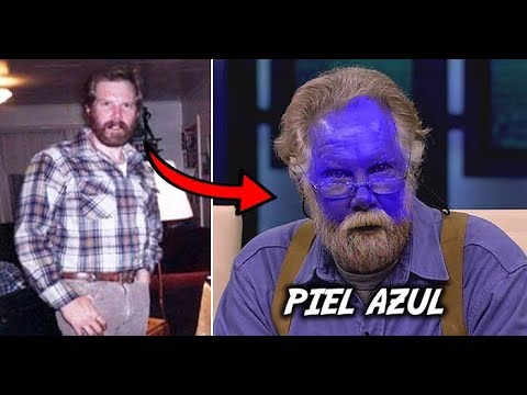 Lesiones Raras Las 7 Enfermedades Más Raras De La Piel - YouTube