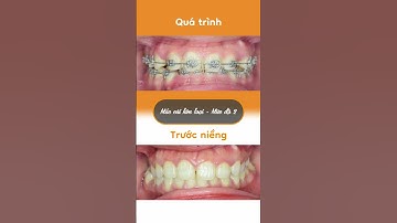 Hành trình LỘT XÁC nhờ niềng răng của Thảo Nhi