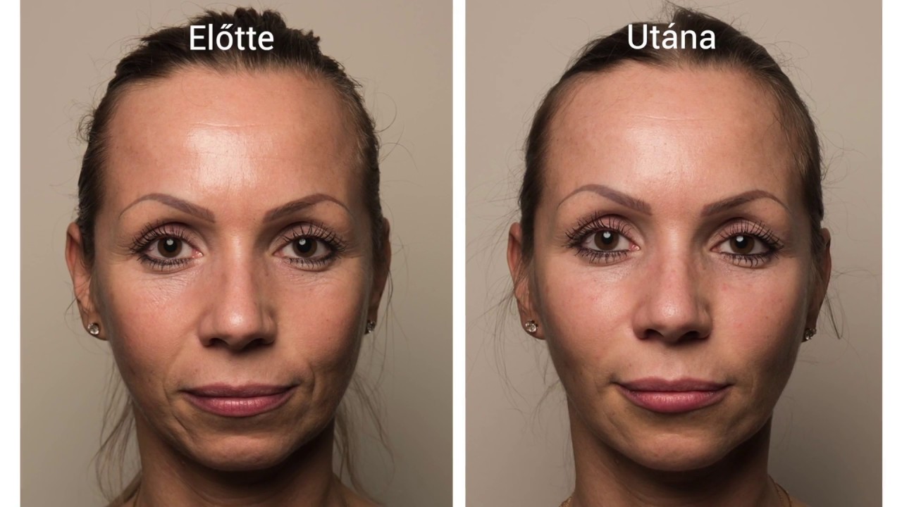 botox ráncfeltöltés)