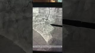 Part #1: Complex Multivessel CAD, involving LM & RCA CTO, IVL-Assisted PCI, Step-by-Step. 