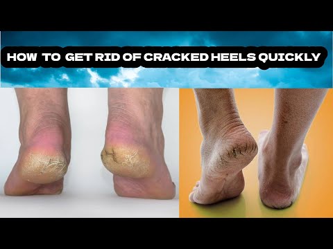 Getting Rid Of Dry And Cracked Feet