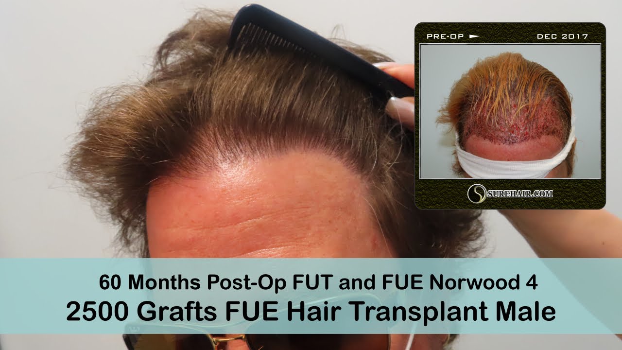 Male 60 months Post-Op FUE