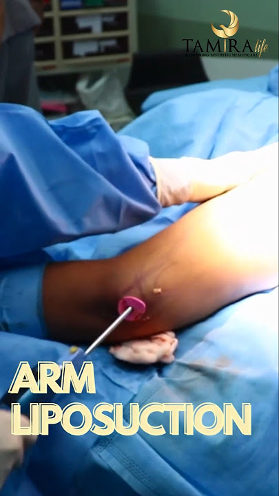 Arm Liposuction Procedure at Tamira | Targeted Fat Removal | Tamira Life