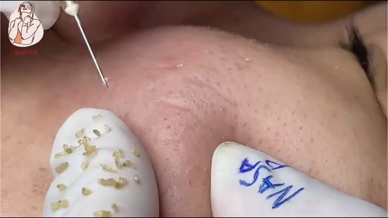 blackhead squeezing 2021