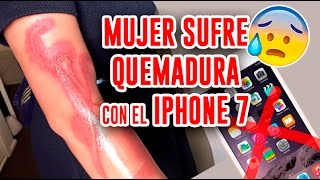 Mujer sufre quemadura en el brazo por iPhone 7