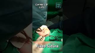 Corner Lip Lift LIVE Surgery in Korea | Corner of the LipLift Procedure by Korean Surgeon shorts