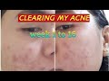 PURGING AND WEEKLY PROGRESS USING EPIDUO | Acne Cure | Philippines