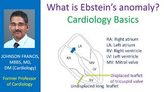 What is Ebstein’s anomaly? Cardiology Basics