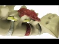 Transforaminal Lumbar Interbody Fusion (TLIF) - DePuy Videos