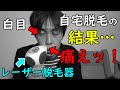 【ヒゲ照射】自宅でセルフ脱毛だぁぁぁ【レーザー脱毛器トリア・使い方】