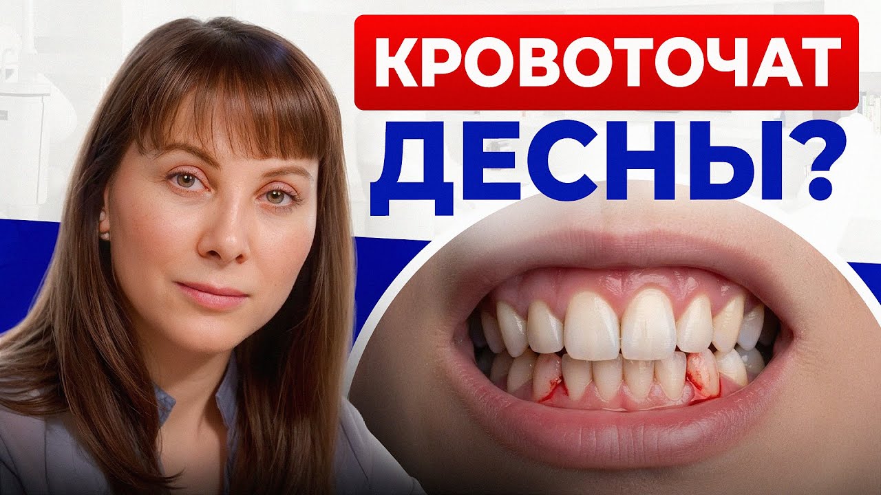 Почему кровоточат ДЁСНЫ при чистке зубов? ЭТИ ошибки могут стоить вам зубов!