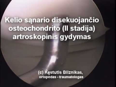 Video: Kelio Artroskopija: Priežastys, Procedūra Ir Nauda