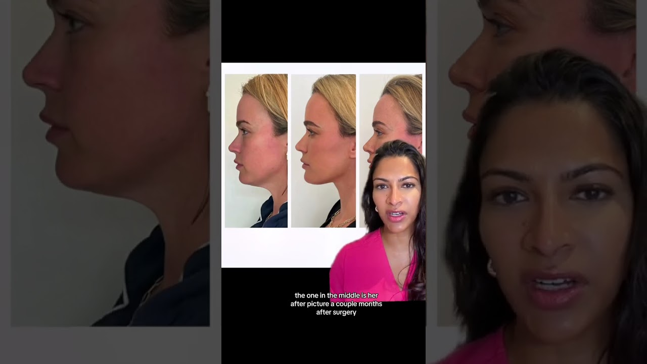 Swelling After Surgery | Neck Lift Healing Process