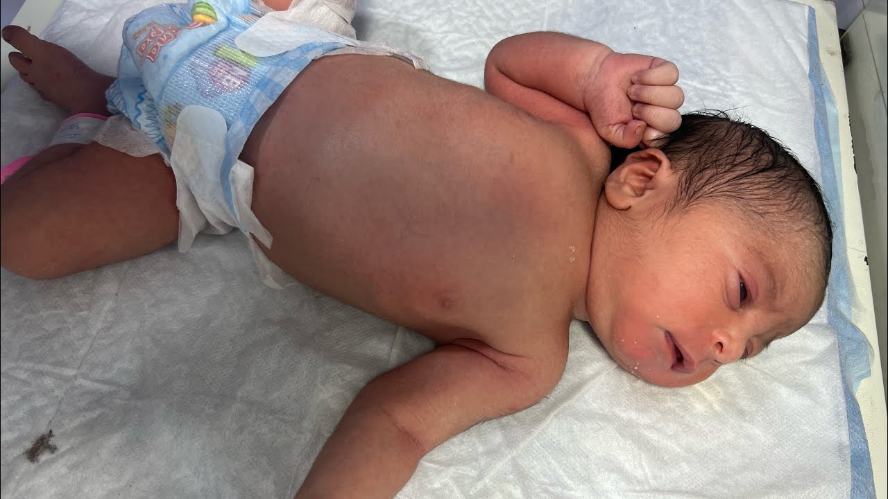 From Critical to Stable – Newborn MAS Baby’s NICU Recovery Journey