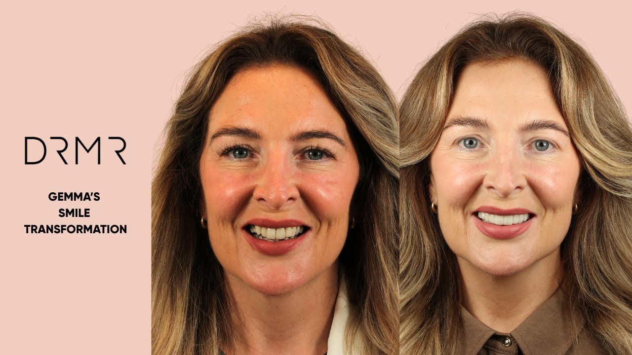 Ep.14: Porcelain Veneers London | DRMR Clinic Smile Makeover Before & After
