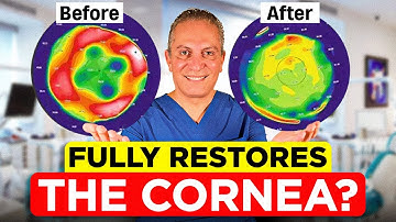 What is Topography-Guided PRK? | Is This The Best Treatment for Astigmatism?