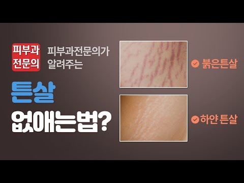 튼살없애는방법?? 알려드립니다.(허벅지,종아리,복부,팔,가슴,튼살제거치료)