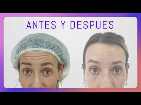 ¿Te molestan las arrugas en la frente? Mira el Botox. Antes y después. #esteticavicentelopez