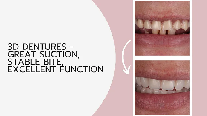 3D Dentures - Great Suction, Stable Bite, Excellent Function