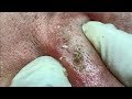 Acne treatment in Ha Quyen Spa on 30/06/2019 part 3 - Điều trị mụn tại Hà Quyên Spa