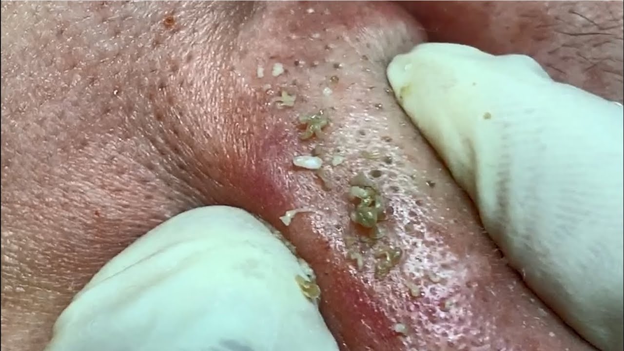 Blackheads removal on the nose