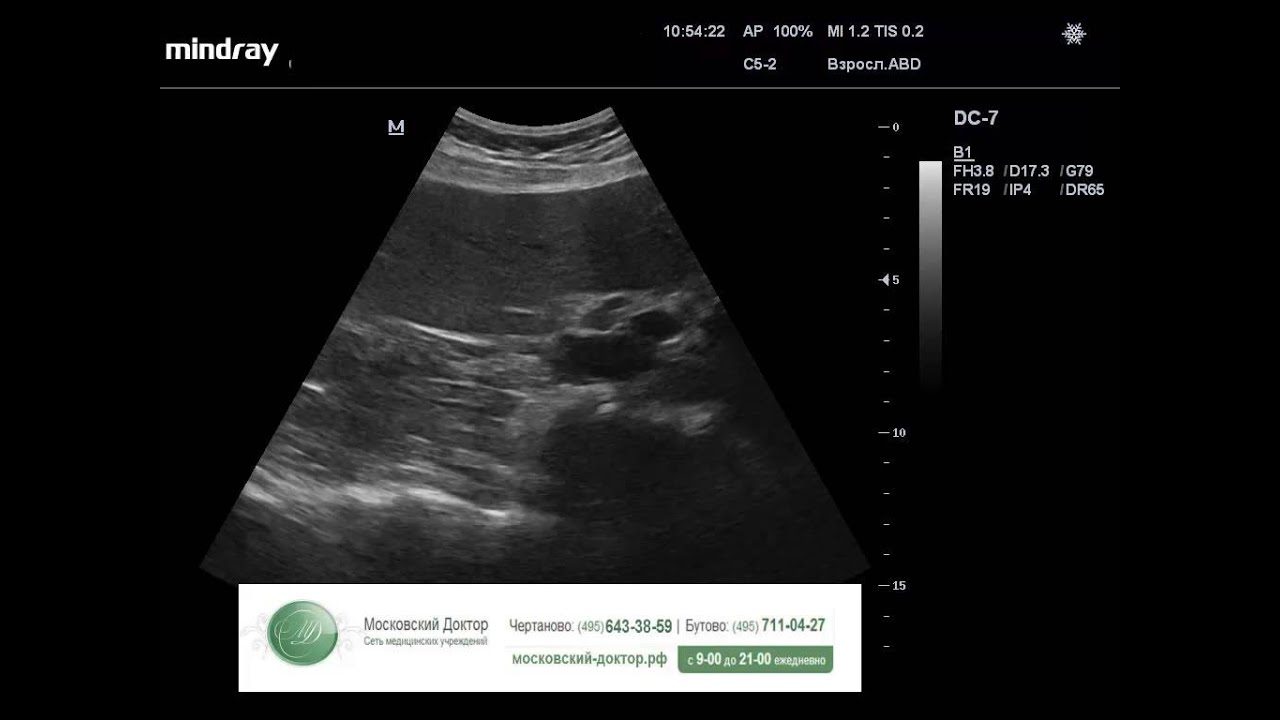 киста бейкера на узи описание. коралловидный нефролитиаз узи. Cmd узи. ультразвуковое исследование почек конкременты. узи при мочекаменной болезни.