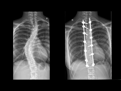 Лечение сколиоза и кифоза | Искривление позвоночника у детей