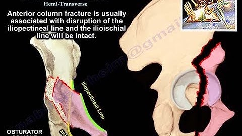 Acetabulum Anterior Wall, Column, Hemi-Transverse - Everything You Need To Know - Dr. Nabil Ebraheim