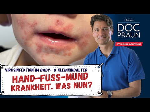 Video: 3 Möglichkeiten zur Vorbeugung von Hand-Fuß-Mund-Krankheit