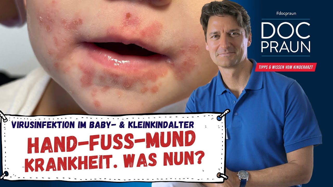 Anfangsstadium Hand Fuß Mund Krankheit HAND-FUSS-MUND-KRANKHEIT - eine typische Krankheit im Kindesalter - YouTube
