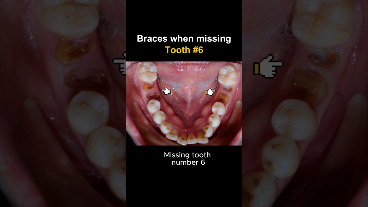 Braces for missing tooth 6 #braces #orthodontist #brackets #dentist