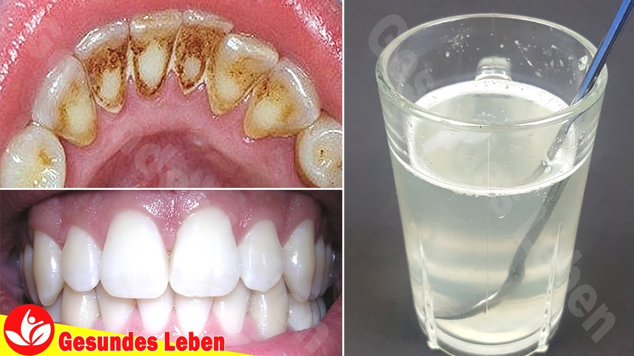 ⁣Entfernen Sie Zahnbelag Und Zahnstein Von Ihren Zähnen Schnell Nur Mit Diesen 3 Inhaltsstoffen