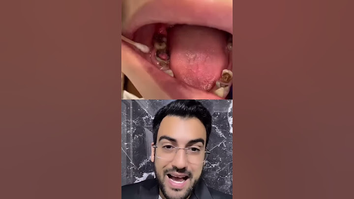 O QUE É ISSO SAINDO DO DENTE?