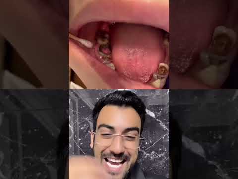 Vídeo: Como comer alimentos duros quando seus dentes doem: 11 etapas