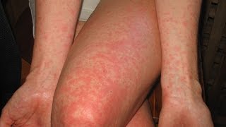 Alcohol Allergy Rash - Asian Flush Treatment