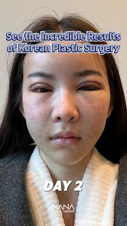 Korean plastic surgery's stunning results #koreanplasticsurgery