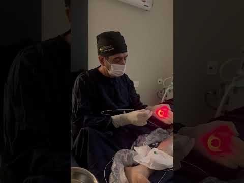Endolaser