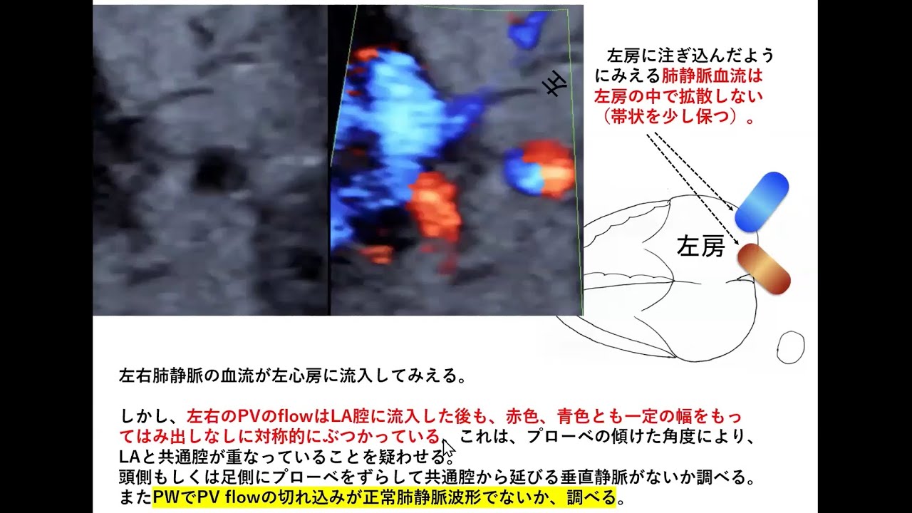 第2回胎児心エコーwebinar 【4ch2】総肺静脈還流異常はカラー