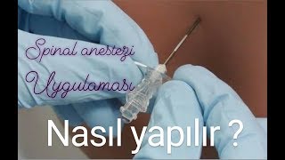 Spinal anestezi (Belden uyuşturma) nasıl yapılır? #Spinal #Anestezi