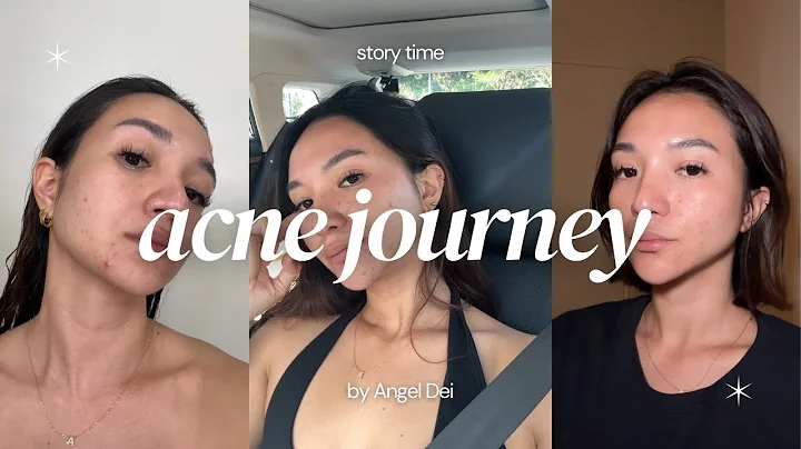 my acne journey (storytime) + current skincare and make up routine | Angel Dei