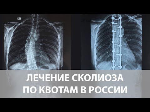 Возможно ли лечение сколиоза по квоте в России?