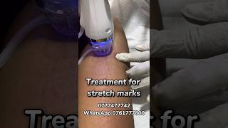 Treatment for Stretch marks #skincenter #skincare #skintreatment #stretchmarks #skincaresrilanka