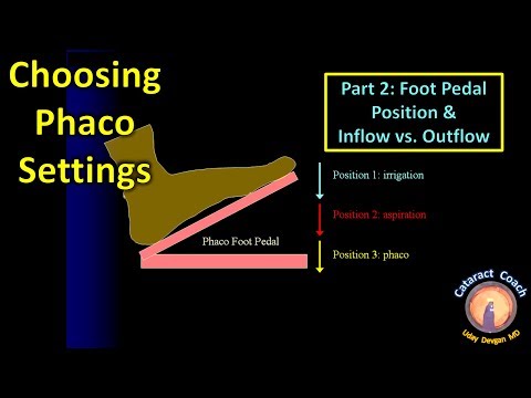 Phaco Fundamentals Part 2: Foot Pedal Position u0026 Inflow vs Outflow