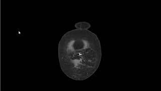 CASE 1069 CT ABDOMEN & PELVIS UMBLICAL HERNIA