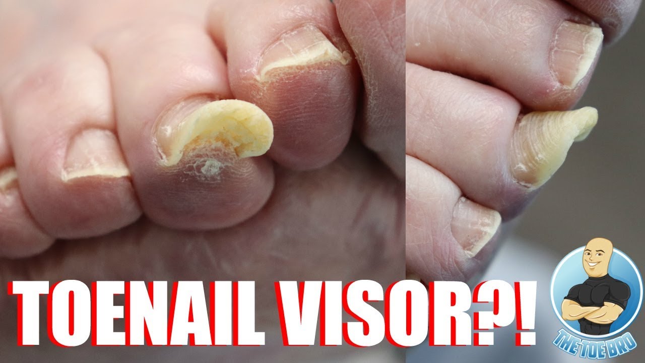 THICKENED AND DEFORMED MIDDLE TOENAIL TREATMENT 