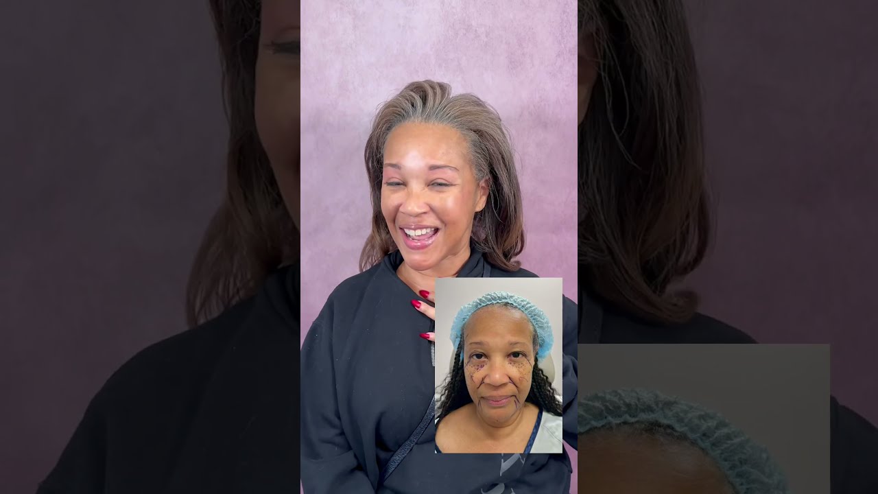 Facelift Takes Off 20 Years Life Changing Plastic Surgery