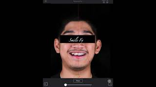 Digital Smile Design using SmileFy App screenshot 1