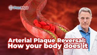 Arterial Plaque Reversal: How your body does it